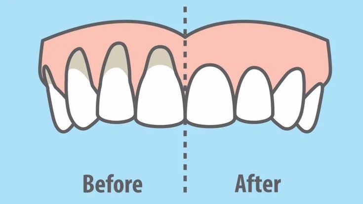 10 Easy Ways To Prevent And Treat Receding Gums Receding Gums Gum