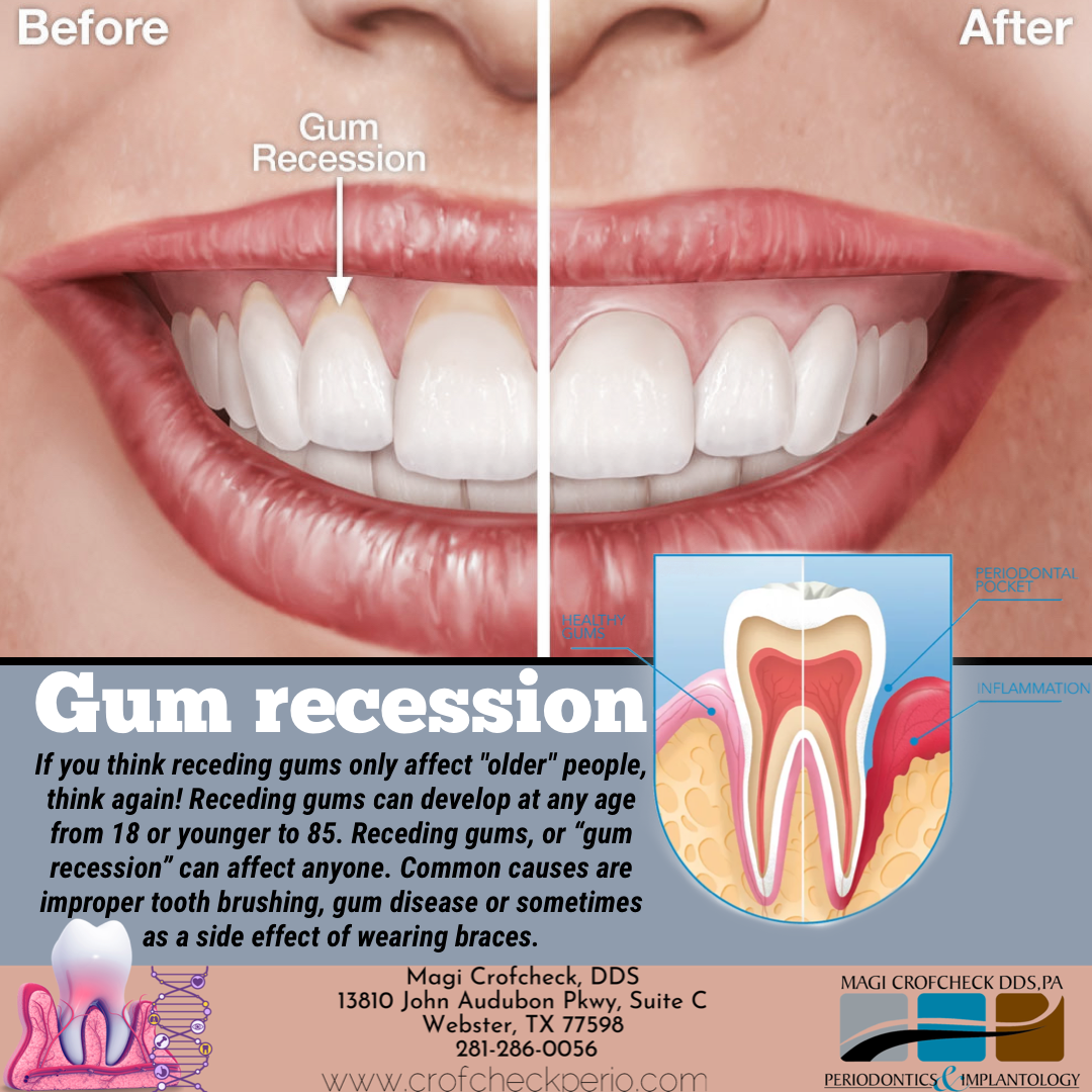 If You Think Receding Gums Only Affect Older People Think Again